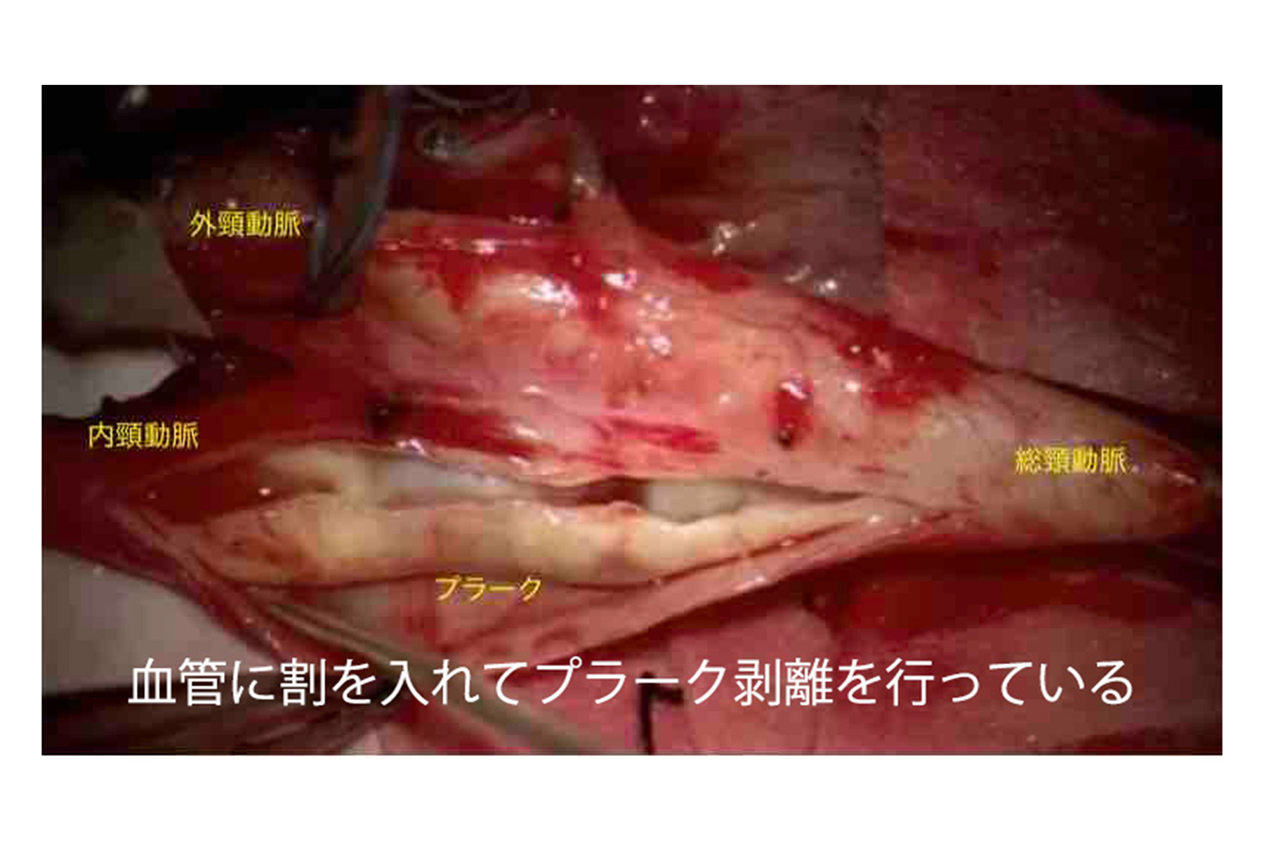 頸動脈ステント留置術について